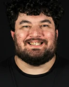 High-quality smile makeover created by expert dentist in Playa del Carmen