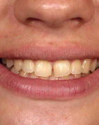 Custom cosmetic dentistry smile makeover by Smile Makeover Playa del Carmen