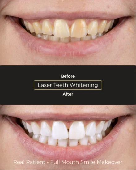 Before and after teeth whitening results at Smile Makeover Playa del Carmen