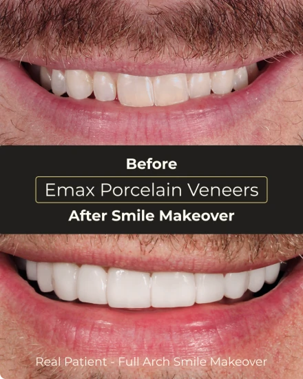Before cosmetic dental treatment at Smile Makeover Playa del Carmen patient review case