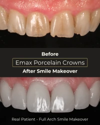 Functional and long-lasting dental bridge and crown results