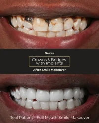 Patient comfortable during restorative dental treatment