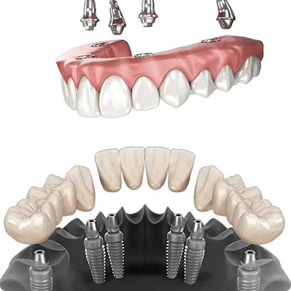 Diagram comparing 3 on 6 dental implants vs All-on-4 full mouth restoration treatment.