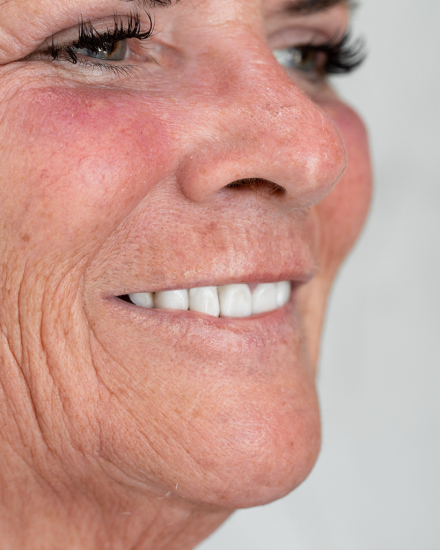 Side profile of female patient showing improved smile and dental restoration results from cosmetic dentistry.
