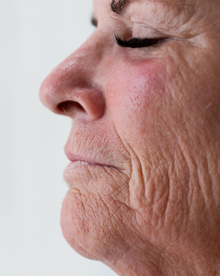 Close-up side profile of patient after smile enhancement treatment performed by an experienced dentist.