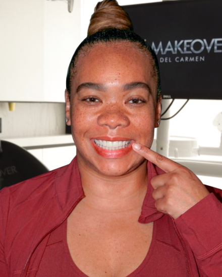 Female patient smiling after dental veneers treatment at an affordable Playa del Carmen dental clinic.