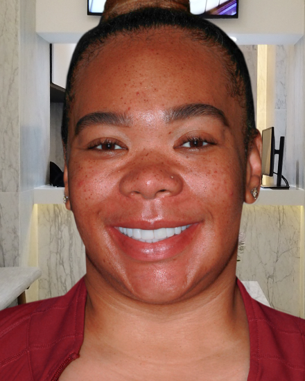 Female patient showing her enhanced smile after receiving veneers and cosmetic dental care in Mexico.