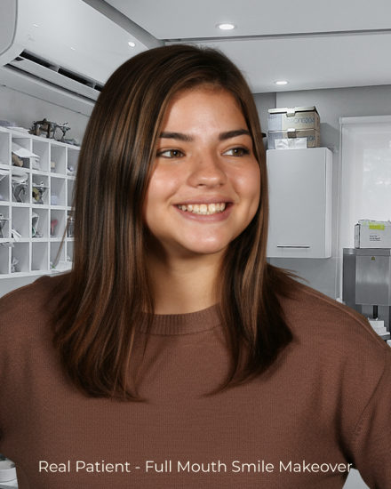 Before image of female patient prior to receiving porcelain veneers and smile makeover treatment.
