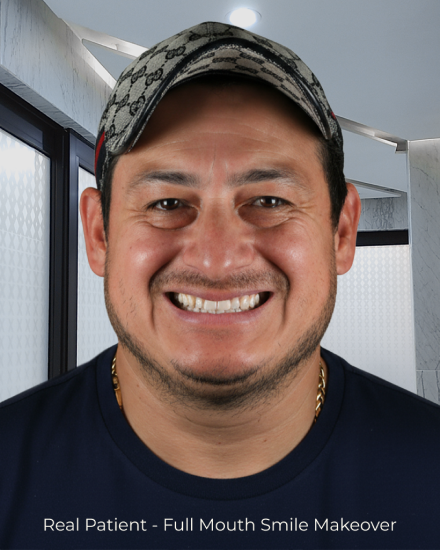 Before image of male patient before cosmetic dental restoration and full smile makeover.