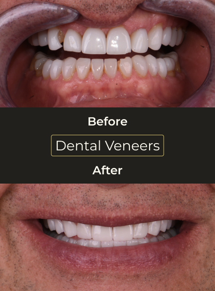 Before and after comparison of dental veneers treatment showing improved tooth color, alignment, and smile aesthetics.
