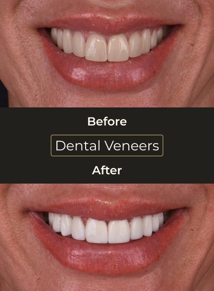 Before and after porcelain veneers results demonstrating a brighter, whiter smile from cosmetic dentistry.