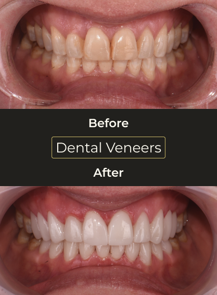 Before and after dental veneers transformation correcting discoloration and improving smile symmetry.