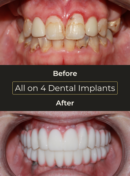 Before and after All-on-4 dental implants treatment showing complete restoration of missing and damaged teeth.