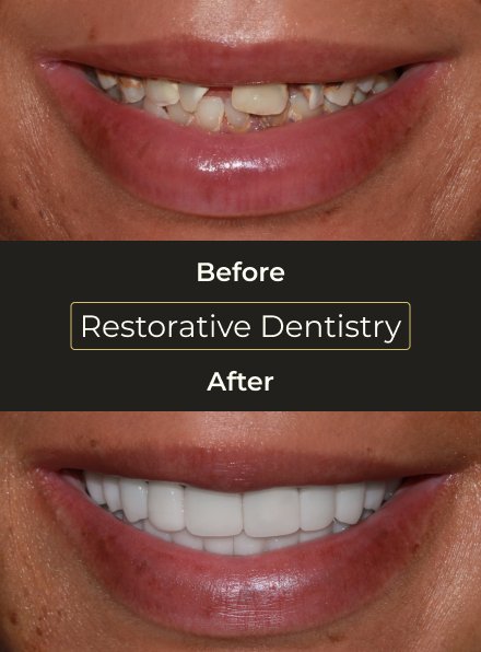 Before and after restorative dentistry treatment featuring enhanced tooth shape, color, and overall smile appearance.