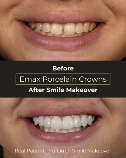 Before and after E-Max porcelain crowns smile makeover performed by a Playa del Carmen cosmetic dentist.