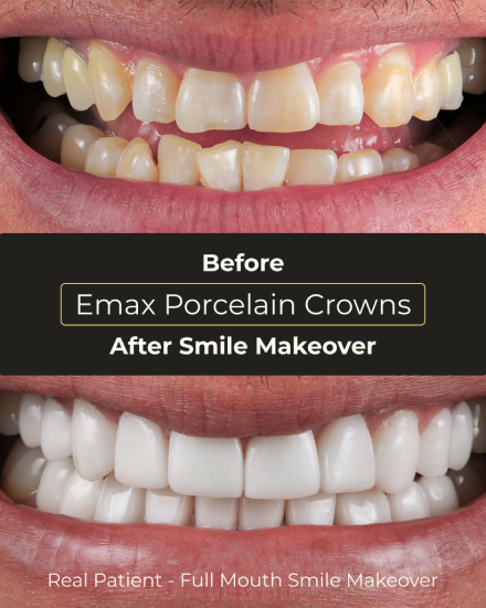 Before and after E-Max porcelain crown treatment showing dramatic smile restoration and natural-looking results.