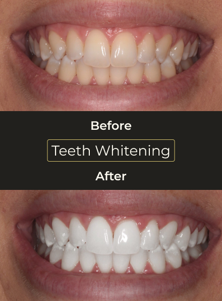 Before and after Zoom teeth whitening treatment revealing a noticeably brighter and whiter smile.