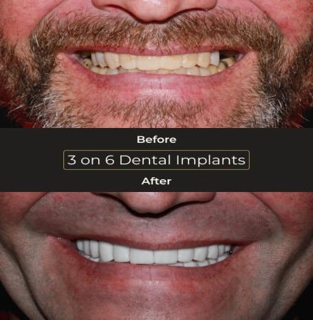 Before and after smile transformation with 3 on 6 dental implants for full mouth restoration.