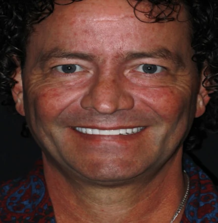 Patient after ful mouth restoration with 3 on 6 dental implants showing natural-looking results.