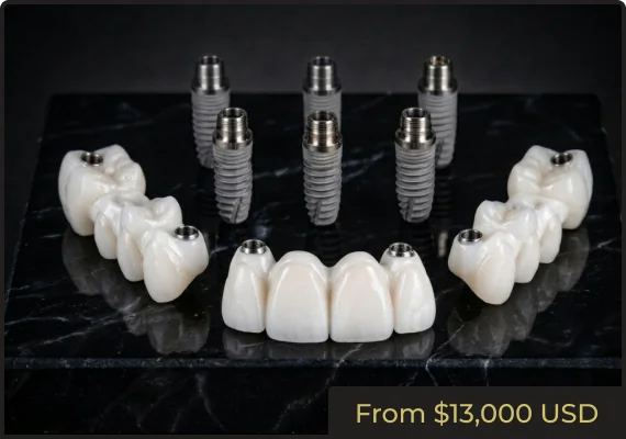 Zirconia bridges supported by six implants used in a 3 on 6 full mouth restoration procedure.