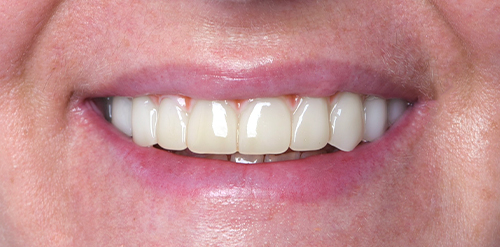 zirconia pretta all on 4 in mexico