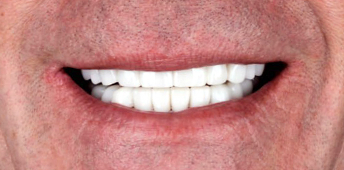 full-mouth-all-on-4-dental-implants