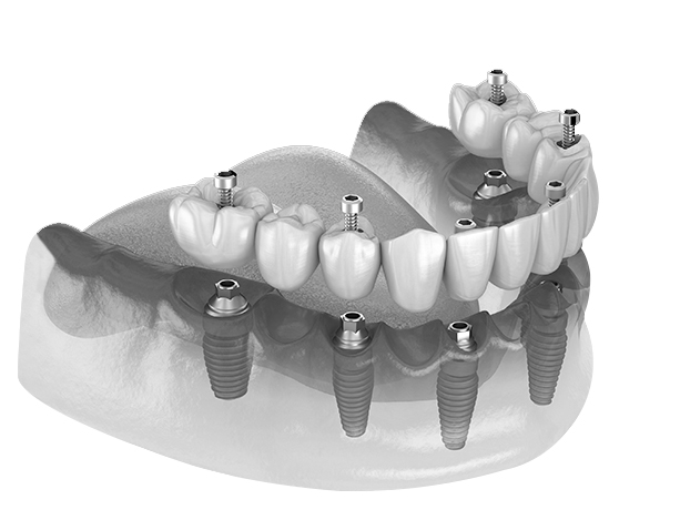 3 on 6 dental implants in playa del carmen