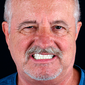 old man showing their 3 on 6 dental implants in mexico