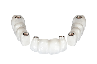 implant supported dental bridges in mexico