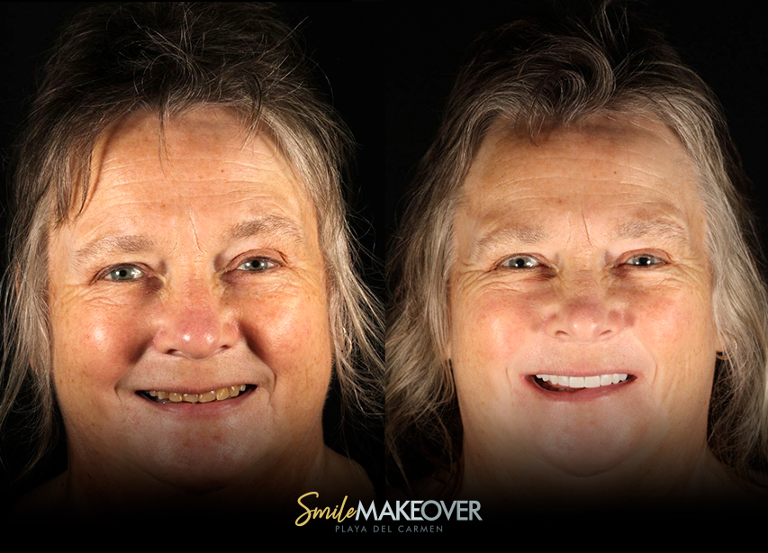 mexico full smile makeover before and after