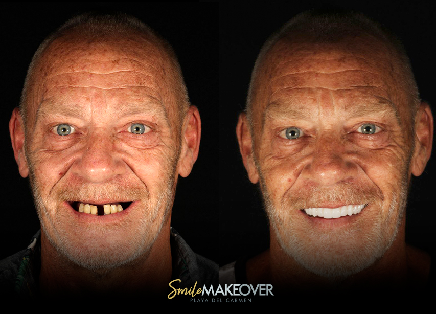 mexico full smile makeover before and after