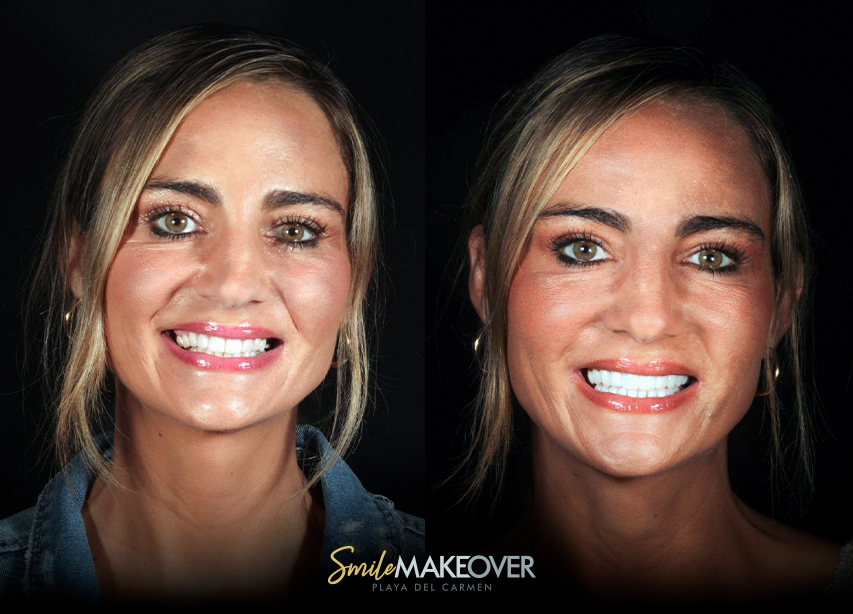 Images of a woman showind before and after veneers in cancun