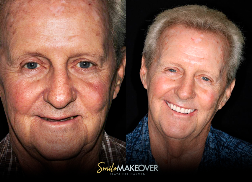 Snap on dentures before and after in mexico