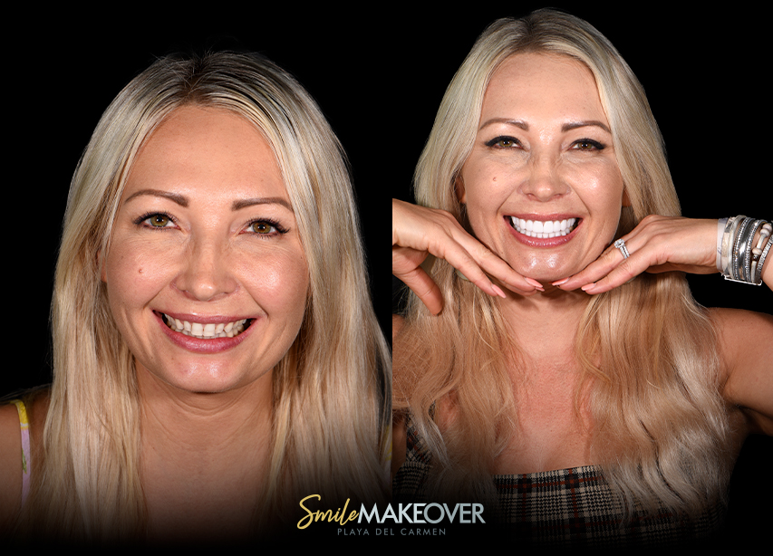 Full mouth dental veneers in smile makeover