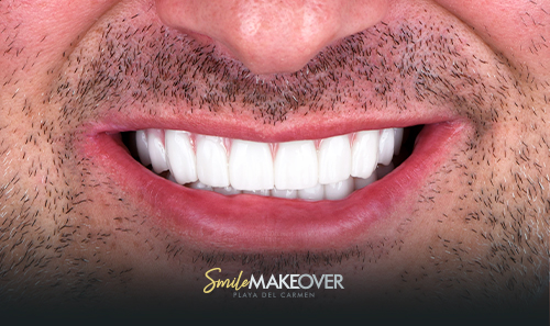 Zirconia dental veneers in smile make-over