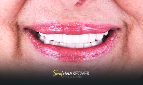 smile makeover playa del carmen reviews