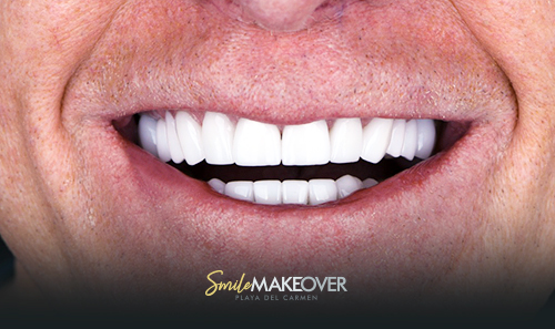 full mouth smile makeover at playa del carmen