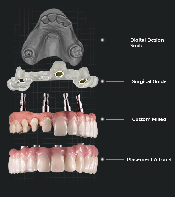 digita smile design process in playa del carmen