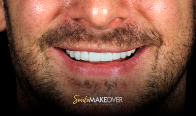 full veneers smile transformation smile makeover