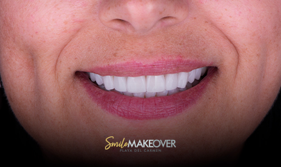 veneers-before-and-after-in-playa-del-carmen