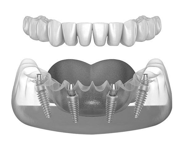 All on 4-denta implants in playa-del-carmen