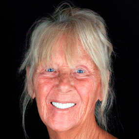 woman smiling thanks to full mouth  dental implants showing  before and after