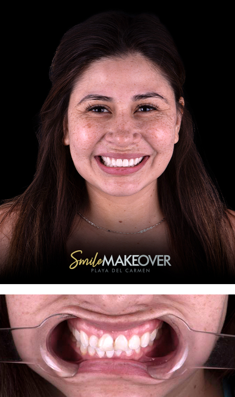 Teeth whitening before and after in playa del carmen