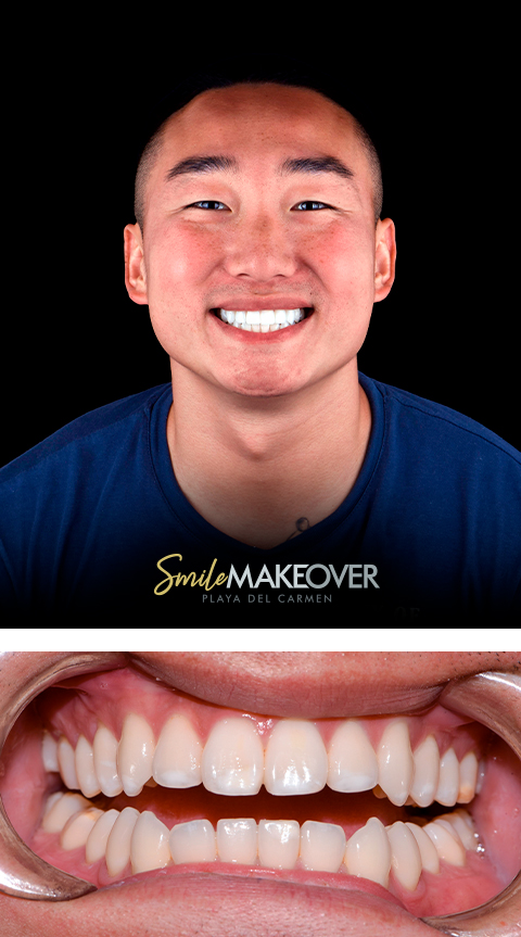 Cosmetic treatment before and after in smile makeover