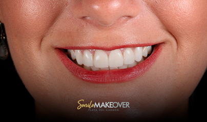 clear aligne at smil makeover