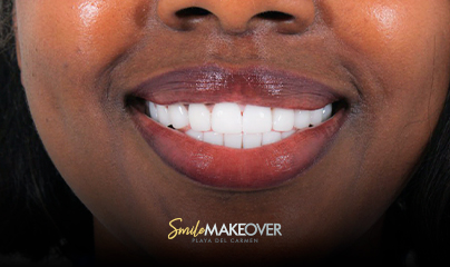 dental veneers before and after