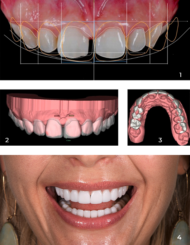 digital smile design in mexico