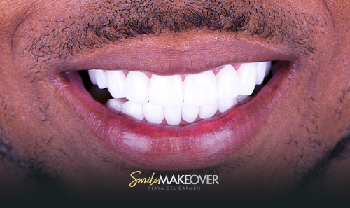 Gum grafting in smile makeover playa de carmen