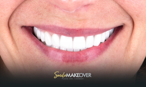 Clear aligner in smile makeove -playa del carmen