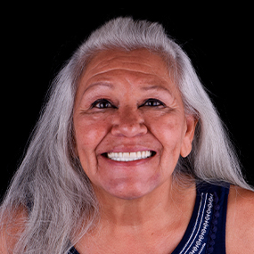 Elderly woman with grey hair with implant based full mouth restoration in mexico